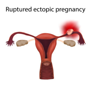 ruptured ectopic pregnancy