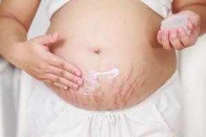 pregnancy-stretch-marks-oils